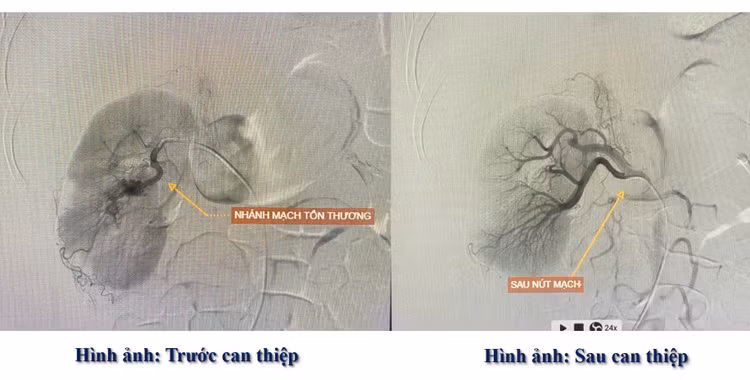 Dị dạng động tĩnh mạch thận hiếm gặp trước và sau can thiệp - Ảnh BVCC
