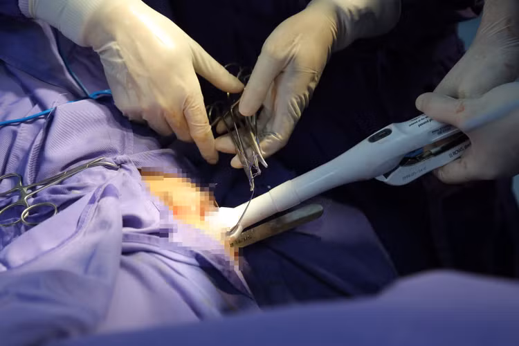 Sử dụng dụng cụ chuyên dụng để cắt túi sa trực tràng - Ảnh BVCC