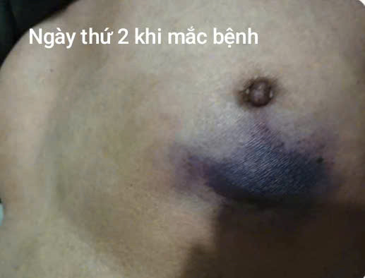 Từ vết nhỏ nấm lan rộng gây hoại tử rất nhanh - Ảnh BVCC