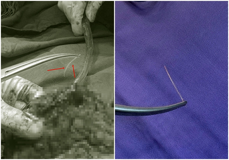 Chiếc xương cá được lấy ra - Ảnh BVCC