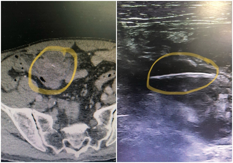 Hình ảnh xương cá đâm thủng ruột bệnh nhân - Ảnh BVCC