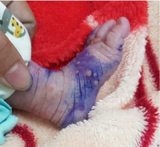 Trẻ sơ sinh bị thủy đậu tại Bệnh viện Đa khoa tỉnh Lạng sơn - Ảnh BVCC