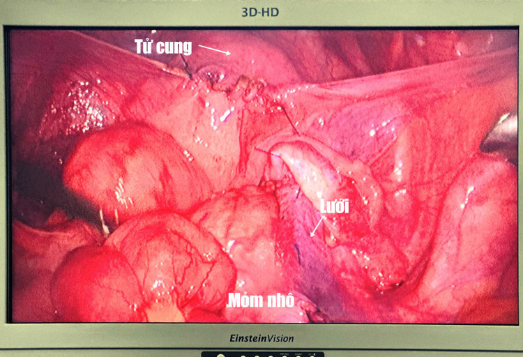 Cận cảnh nội soi đặt lưới nâng tử cung - Ảnh BVCC