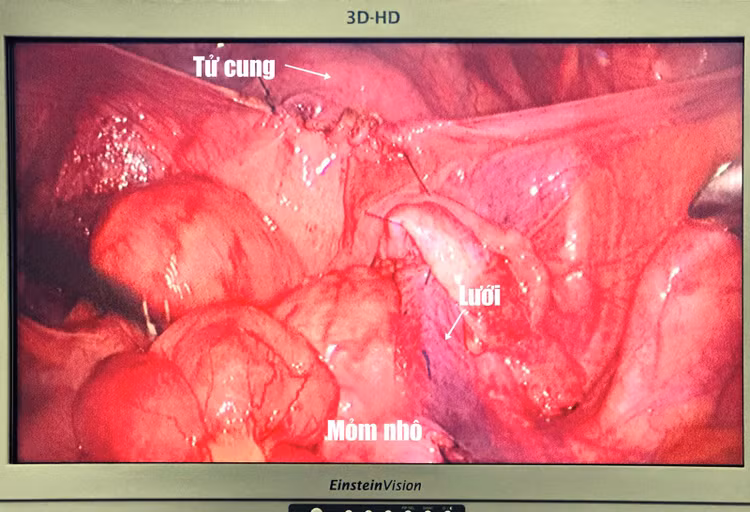 Cận cảnh nội soi đặt lưới nâng tử cung - Ảnh BVCC