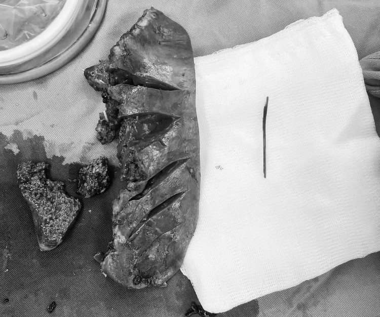 Khối áp xe gan được cắt bỏ cùng với chiếc tăm được lấy ra - Ảnh BVCC