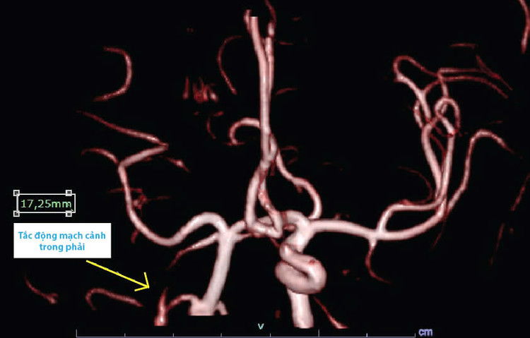 Biểu hiện tắc mạch trên phim chụp mạch - Ảnh BVCC