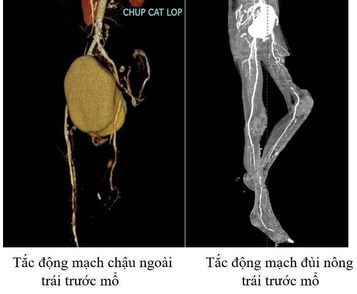 Hình ảnh chân người bệnh khi đến bệnh viện mỏm cụt chân trái vẫn tiếp tục hoại tử