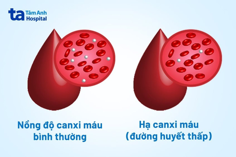 Biểu hiện hạ canxi khi xét nghiệm máu.