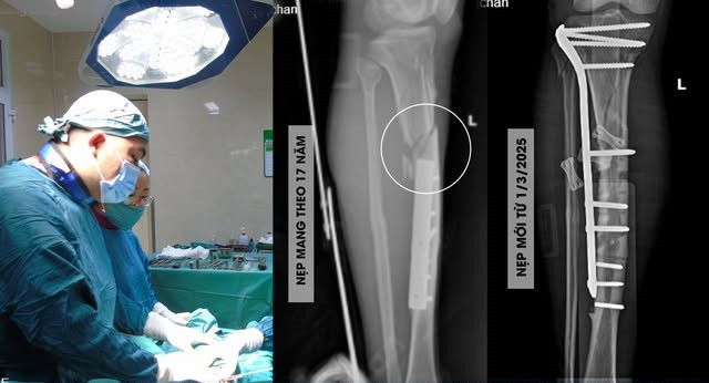 Ca phẫu thuật cho bệnh nhân - Ảnh BVCC