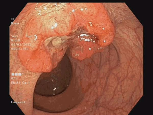 Khối u của bệnh nhân trên phim chụp - Ảnh BVCC