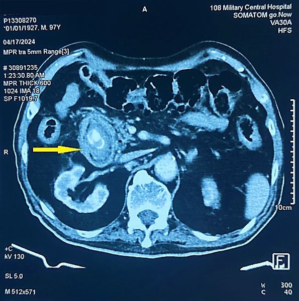 Hình ảnh sỏi trên phim chụp - Ảnh BVCC