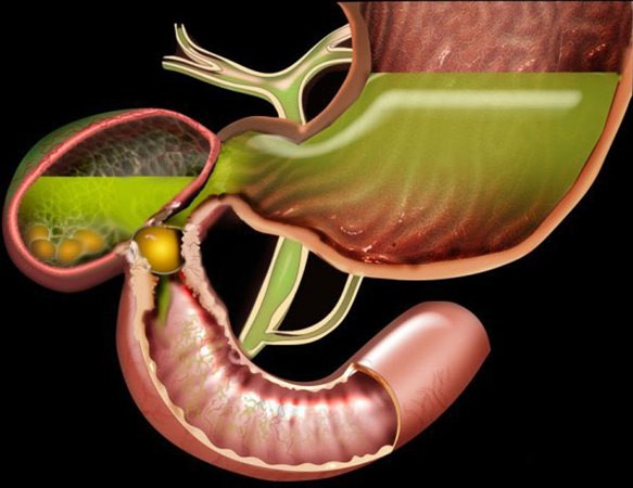 Tắc ruột do sỏi - Ảnh minh họa