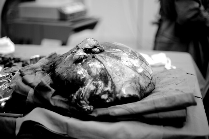 Khối u sau mổ nặng 7,25kg, kích thước 30x40cm - Ảnh BVCC