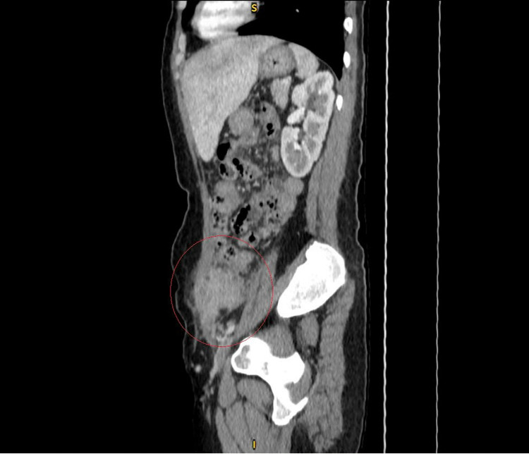 Hình ảnh rò túi thừa trên phim chụp - Ảnh BVCC