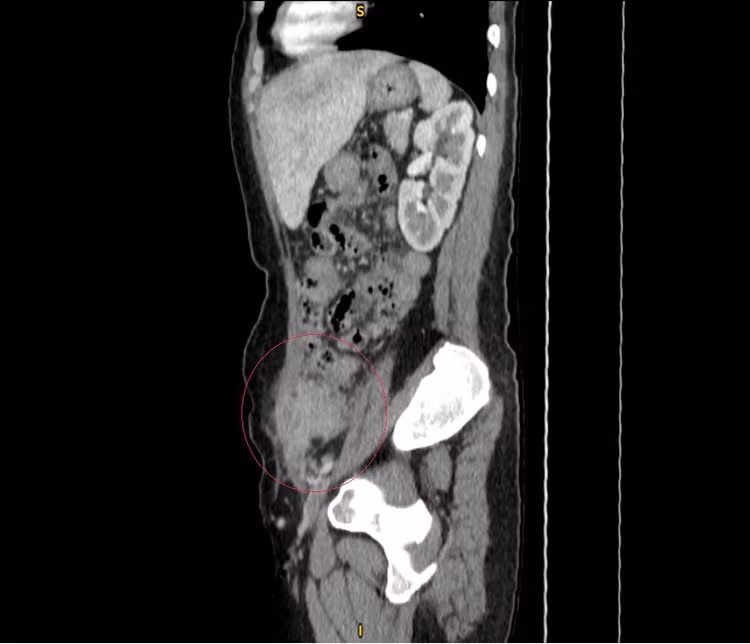 Hình ảnh rò túi thừa trên phim chụp - Ảnh BVCC