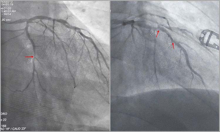 Hình ảnh động mạch mũ (trái) và động mạch liên thất trước (phải) hẹp nặng - Ảnh BSCC