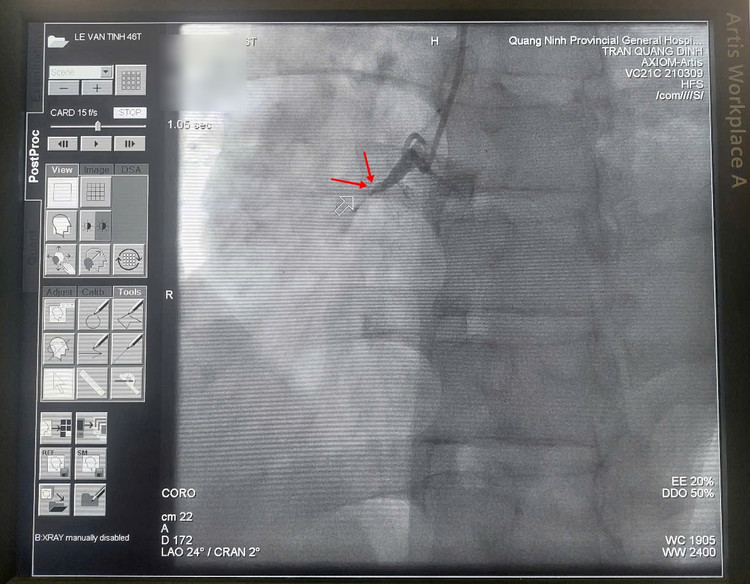 Hình ảnh động mạch mũ (trái) và động mạch liên thất trước (phải) hẹp nặng.