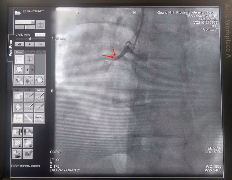 Hình ảnh động mạch mũ (trái) và động mạch liên thất trước (phải) hẹp nặng.