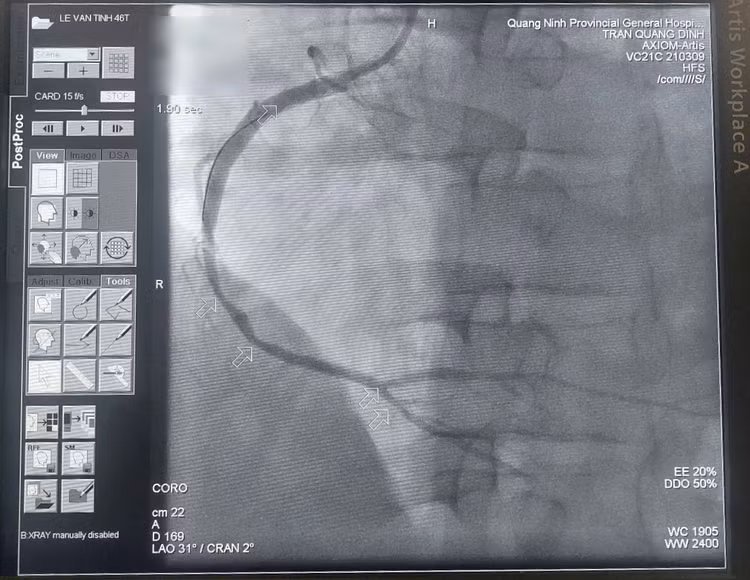 Kíp bác sĩ khoa Phẫu thuật và Can thiệp Tim mạch đặt stent tái thông mạch vành phải - Ảnh BSCC