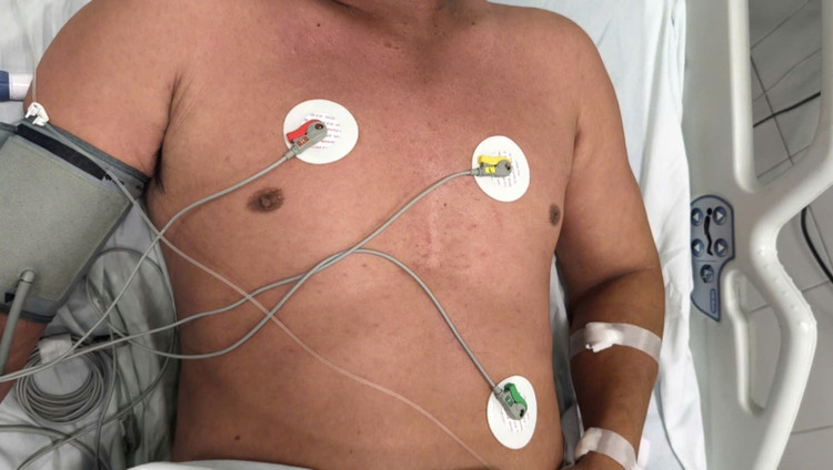 Suy hô hấp cấp do mắc sởi - Ảnh BVCC