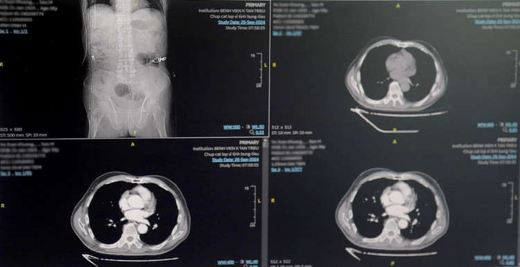 Khối u của bệnh nhân trên phim chụp - Ảnh BVCC