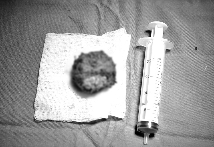 Toàn bộ tuyến tiền liệt kèm khối ung thư được phẫu thuật nội soi lấy ra thành công. Toàn bộ tuyến tiền liệt kèm khối ung thư được phẫu thuật nội soi lấy ra thành công.