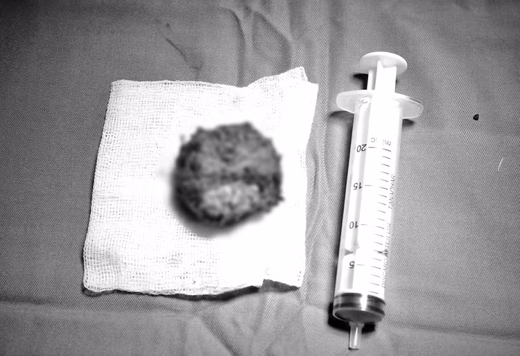 Toàn bộ tuyến tiền liệt kèm khối ung thư được phẫu thuật nội soi lấy ra thành công.