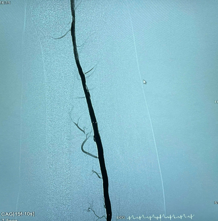 Can thiệp nội mạch “cứu” chân hoại tử cho người tắc động mạch chi dưới ảnh 3