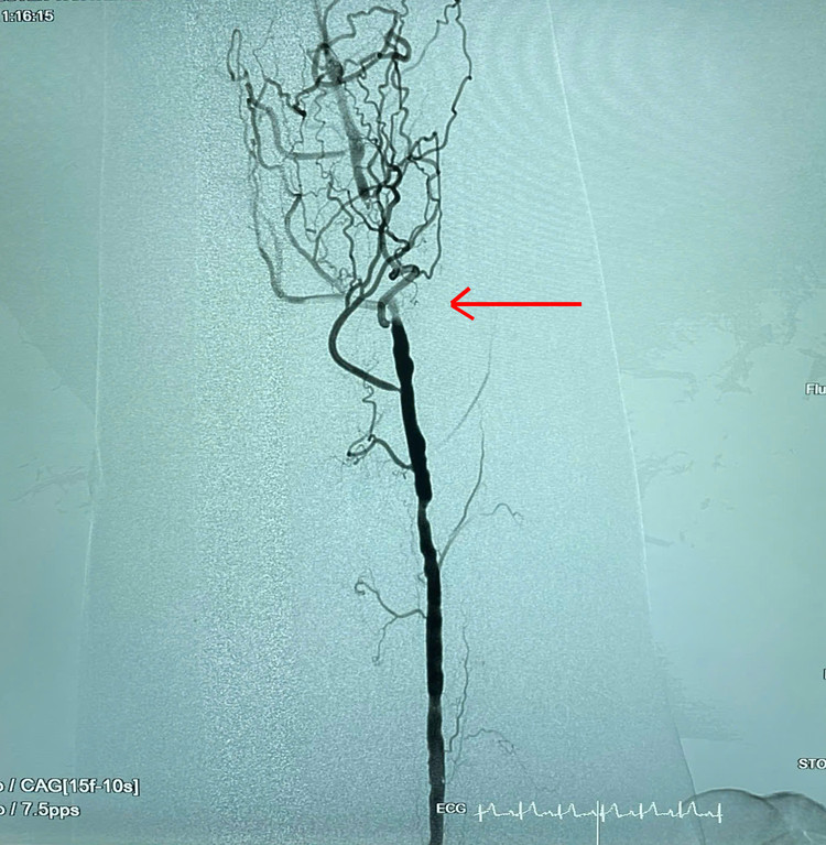 Can thiệp nội mạch “cứu” chân hoại tử cho người tắc động mạch chi dưới ảnh 2