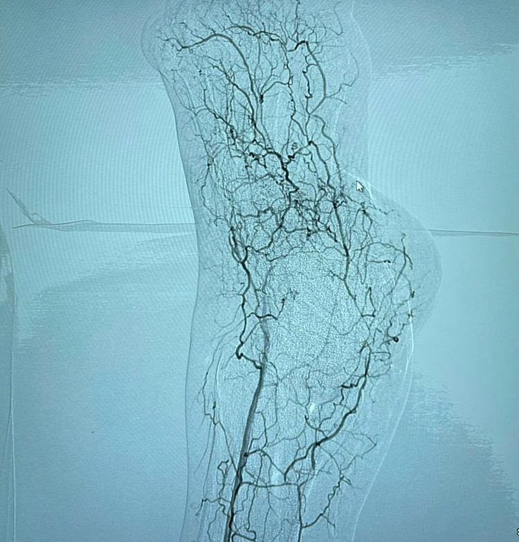 Hình ảnh tưới máu bàn chân sau can thiệp - Ảnh BVCC