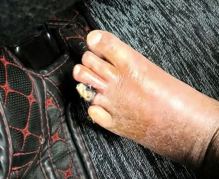 Hình ảnh bàn chân của người bệnh khi nhập viện - Ảnh BVCC