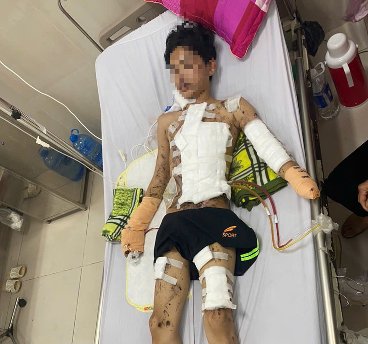 Nam sinh gặp nhiều thương tổn vì pháo tự chế - Ảnh BVCC