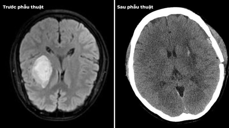 Xuất huyết não do tăng huyết áp trên phim chụp trước và sau mổ - Ảnh BVCC