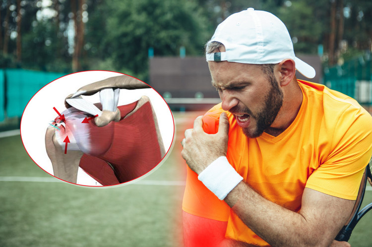 Đau khớp vai nhiều, mất dạng khớp vai là triệu chứng rách chóp xoay - Ảnh BVCC