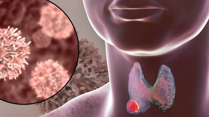 Bác sĩ chỉ rõ những nguy cơ, chẩn đoán và điều trị ung thư tuyến giáp - Ảnh minh hoạ