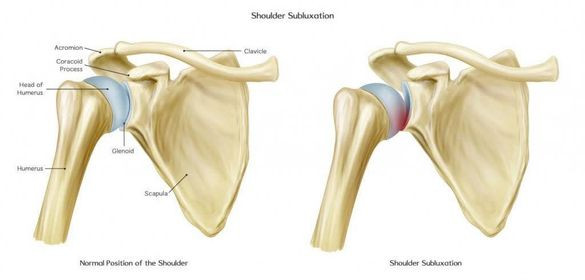 Hình ảnh minh hoạ khớp vai bình thường (hình trái) và bán trật khớp vai (hình phải)