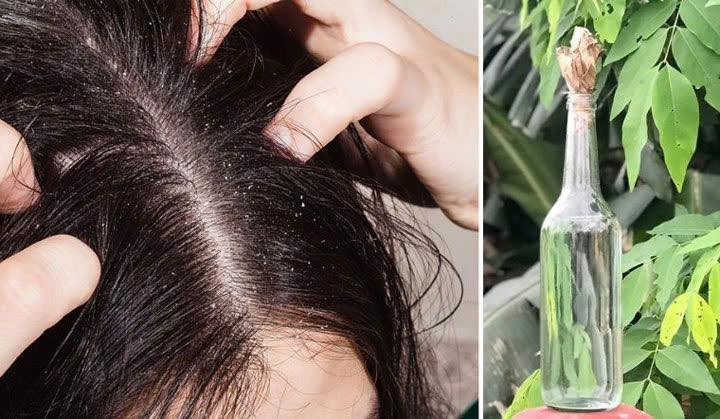 Ủ chấy bằng rượu ngâm hạt na hai mẹ con bỏng giác mạc phải nhập viện