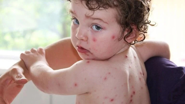 Mùa xuân là thời điểm rất nhiều trẻ bị mắc bệnh thủy đậu