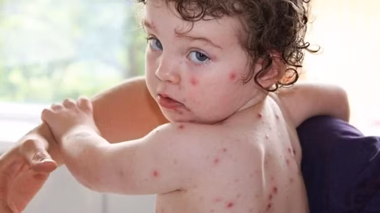 Mùa xuân là thời điểm rất nhiều trẻ bị mắc bệnh thủy đậu