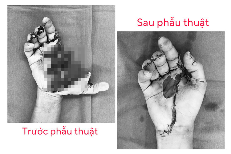 Tổn thương bàn tay của bệnh nhân. Tổn thương bàn tay của bệnh nhân.