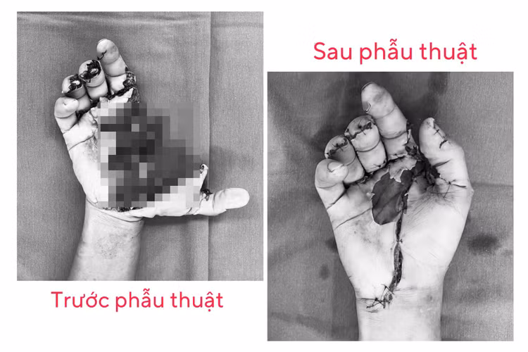 Tổn thương bàn tay của bệnh nhân.