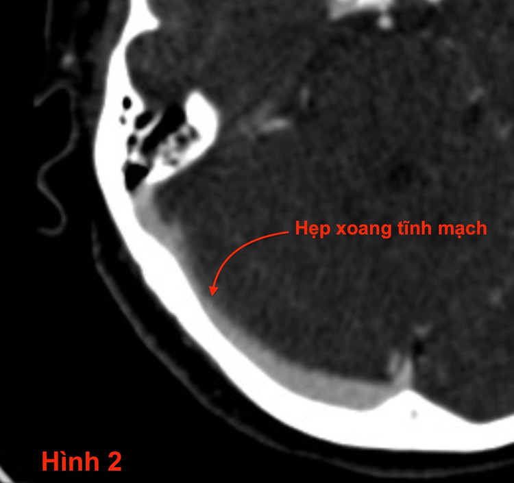 Hình ảnh hẹp xoang tĩnh mạch trên phim chụp - Ảnh BSCC