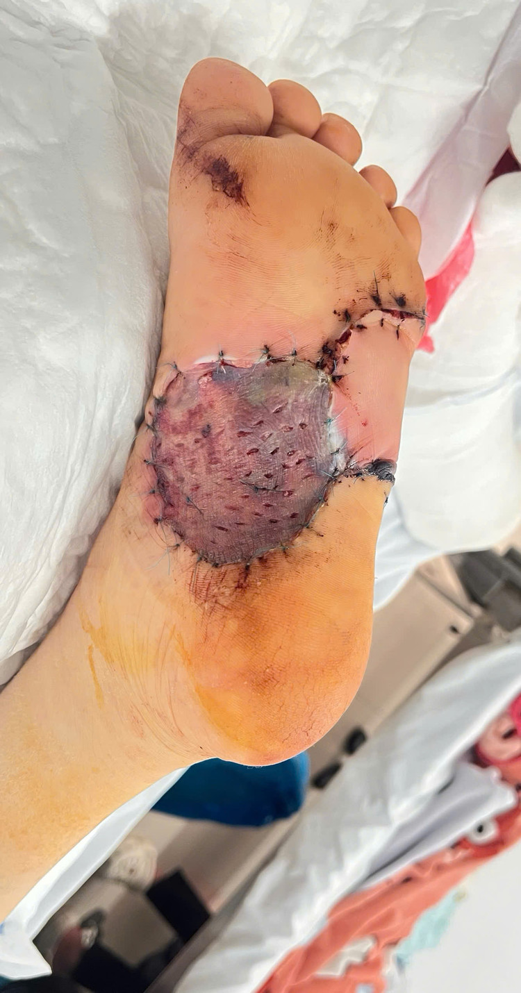 Suýt mất bàn chân vì chủ quan nốt ruồi nhỏ không ngờ ung thư hắc tố ảnh 1