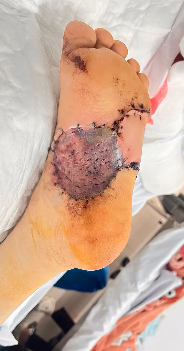 Suýt mất bàn chân vì chủ quan nốt ruồi nhỏ không ngờ ung thư hắc tố ảnh 1 Suýt mất bàn chân vì chủ quan nốt ruồi nhỏ không ngờ ung thư hắc tố ảnh 1