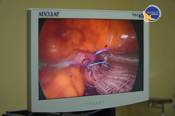 Khâu treo tử cung, chấm dứt phiền toái do sa sinh dục gần 20 năm - Ảnh BVCC