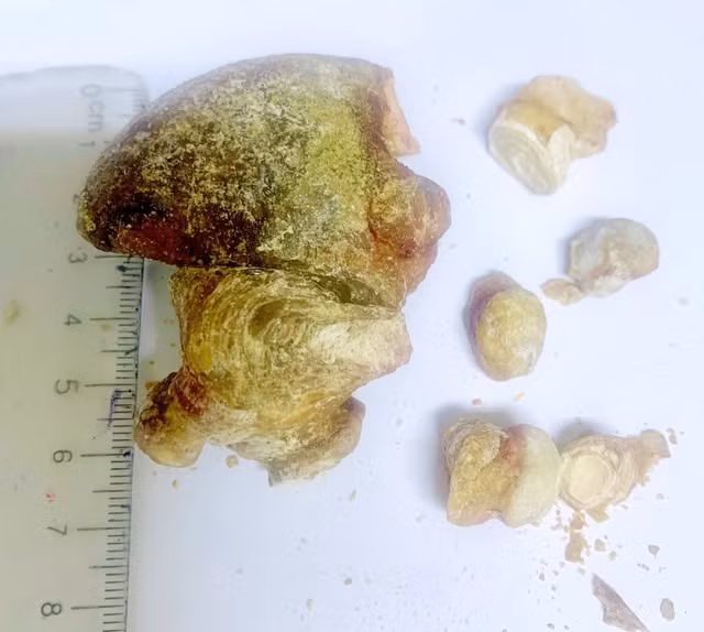 Khối sỏi san hô lớn được lấy ra khỏi thận bệnh nhân - Ảnh BVCC