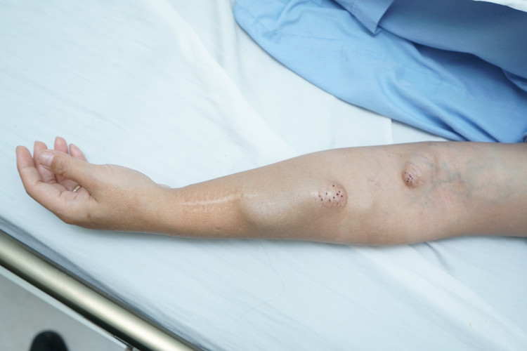 Đặt cầu nối cho bệnh nhân - Ảnh BVCC