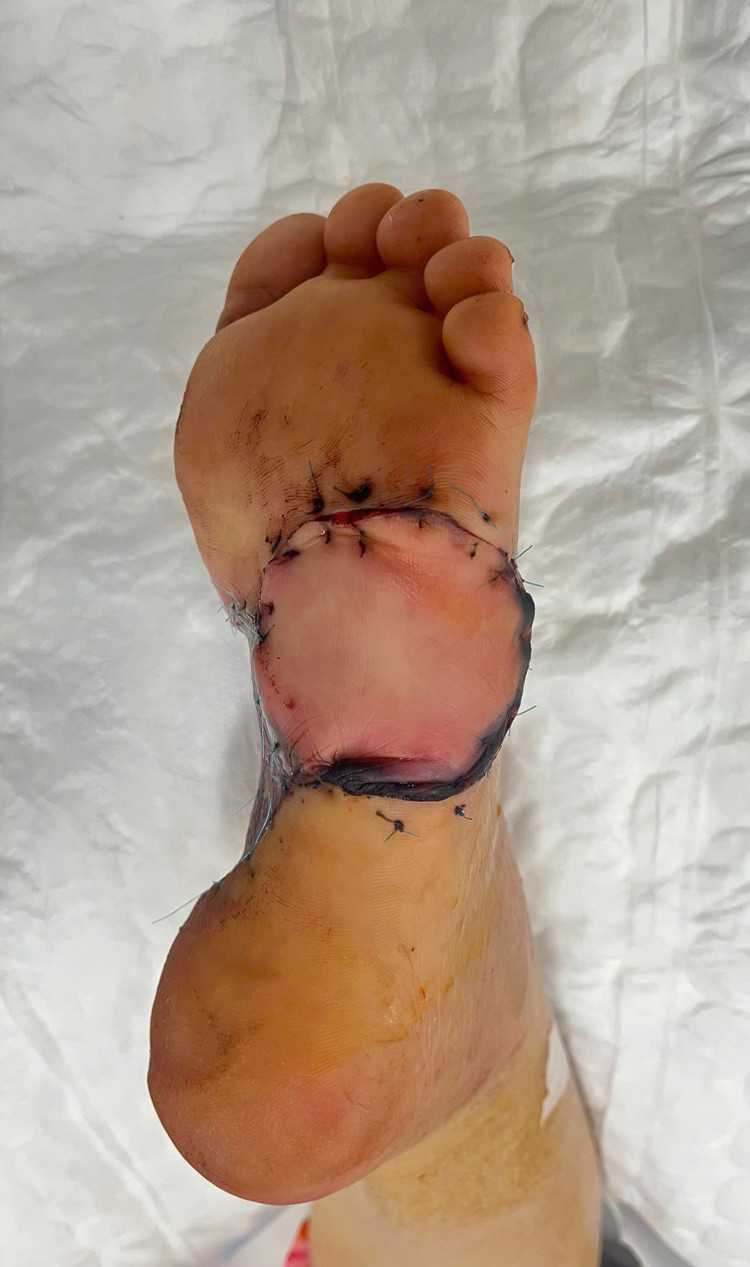 Suýt mất bàn chân vì chủ quan nốt ruồi nhỏ không ngờ ung thư hắc tố ảnh 2