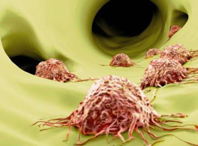 bệnh ung thư cố bám víu vào Fucoidan có thể dẫn tới di căn