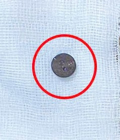 Cúc áo đã được lấy ra thành công - Ảnh BVCC